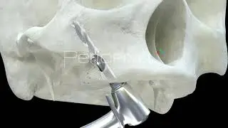 Vídeo 3D Implantes zigomáticos - Tráiler
