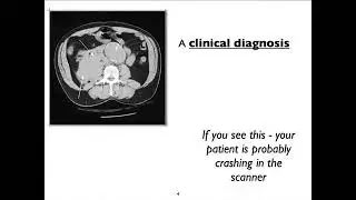 Vascular surgery - AAA (abdominal aortic aneurysm)