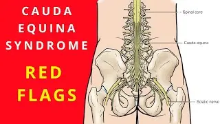 Cauda Equina Syndrome - Red flags symptoms you must know