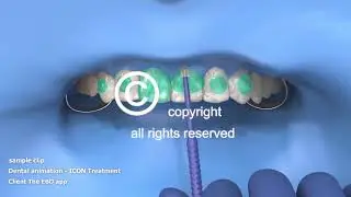 ICON Treatment -  Animation