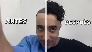 HAIR TRANSPLANT COMPLETE PROCESS 1 MONTH (INTERVENTION, CARE, WASHING, SHOCK LOSS)