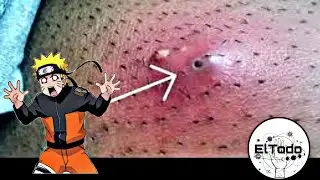 Extracción de granos y quistes part 2.⚠️