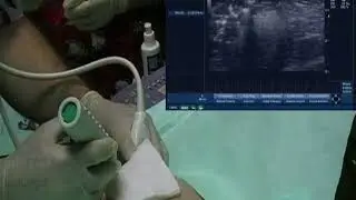 BREAST CORE BIOPSY