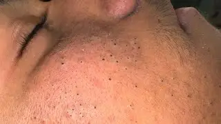 Tranquil Skin Therapy ASMR — Effective Solutions for Blackheads and Acne