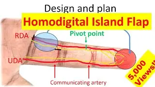How to design and perform a homodigital island flap