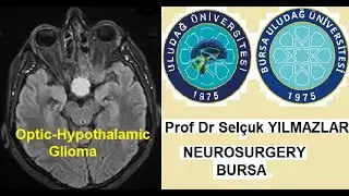 Optic hypothalamic tumor operated by Prof Dr Selçuk YILMAZLAR