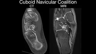 Cuboid and Navicular Coalition