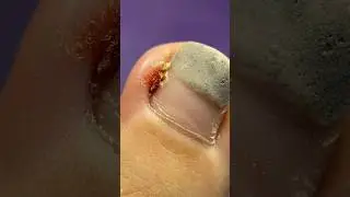 Течёт и ПУЗЫРИТСЯ!😱Что с Ногтем?педикюр ПЕРЕВОПЛОЩЕНИЕ.ДО/После #nails #tutorial #nailart #pedicure