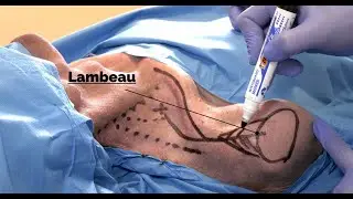 Le lambeau supra-claviculaire