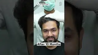 Ten Months Hair Transplant Result | Latest Fue Technique 