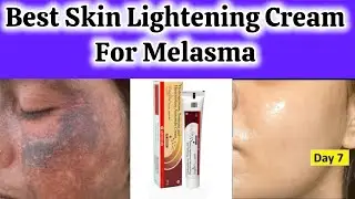 काले दाग धब्बे को साफ कर के गोरा कर देता है| Best skin lightening cream| Triglow cream| melasma|