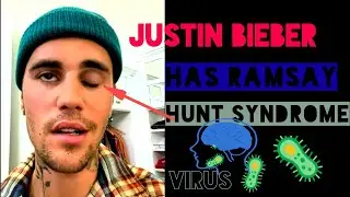 Justin Bieber Tangguh Konsert, Muka Senget Sebelah Akibat Diserang Virus