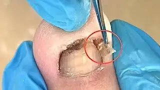Small sharp corners left on toenails, remove it【TD Foot care】