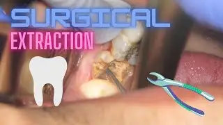 Surgical tooth extraction