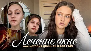 МОЯ ИСТОРИЯ АКНЕ: прыщи длиною в 2 года!