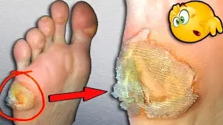 Removing Corns With Knife 🔪👣 Pedicure Scalpel. Core Corn. MASSIVE CORN. Pedicure Feet Step by Step