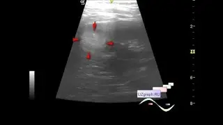 Pediatric renal ultrasound - Hyperechoic segment of the kidney