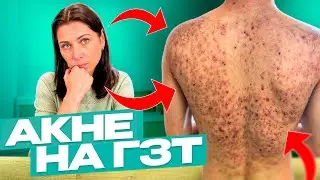 Acne on HRT