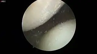Pembersihan kesan gout di lutut, Gout Operation at knee. Part 2