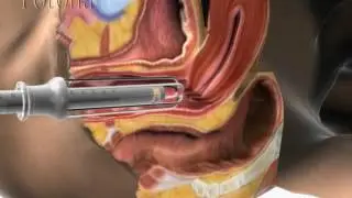 REJUVENECIMIENTO VAGINAL CON LASER FOTONA