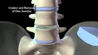 Lumbar Surgery Animation