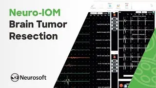 Intraoperative monitoring in brain tumor resection | Neuro-IOM
