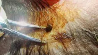 How To Remove a Tick in the ER