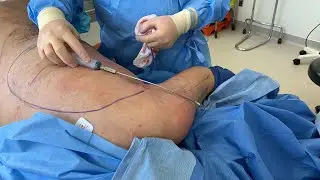 SCULPTED BODYBUILDER ARMS WITH FAT GRAFTING TO SHOULDERS AND GLADIATOR LIPOSUCTION | Dr. JASON EMER