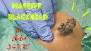 Massive 15 year Blackhead. Dr Khaled Sadek. LipomaCyst.com