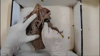 Nasal cavity - meatus and conchae