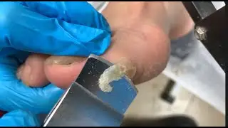 Calluses on toes, cut clean【TD Foot care】