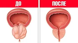 Борьба с простатой: Натуральный напиток, который работает!