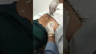 Removal of stitches 03 August 2023#AIIMS Delhi