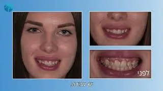 טיפול משולב בלייזר, יישור שיניים וציפויי חרסינה – סביון מדיקל סנטר