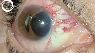 Ophthalmic Signs Anterior Segment