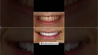 Prep-less smile with ten upper porcelain veneers!🔥🦷 #shorts #dallas #cosmeticdentistry #veneers