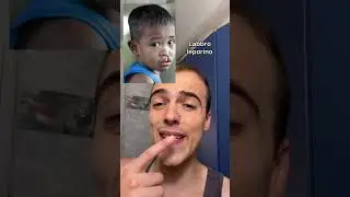 Labbro leporino  #medicina #labbroleporino