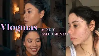 El Acné y La Salud Mental + ¿Porqué dejé Youtube? l VLOGMAS #4