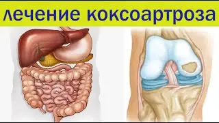 Коксоартроз. Главная ошибка в лечении суставов.