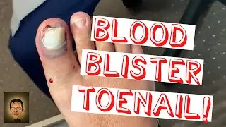 Toenail Contusion Injury with BLOOD Under Toenail