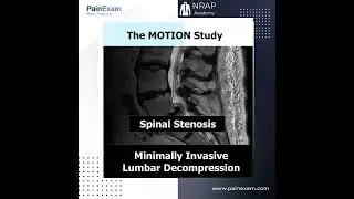 Minimally Invasive Lumbar Decompression- The MOTION Study