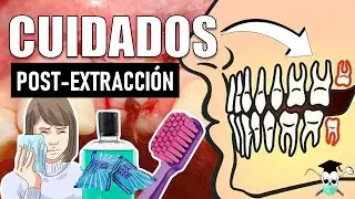 CUIDADOS después de una EXTRACCIÓN DENTAL *7 Tips*