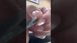 How to take stitches out of your hand instead of going back to the emergency room or doctor Tutorial