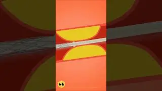 Stent Placement Animation