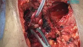 Vulvectomía radical/ Radical vulvectomy