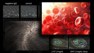 DHT-Bound SHBG and Hair Loss