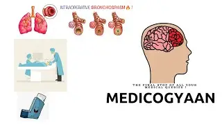 INTRAOPERATIVE BRONCHOSPASM