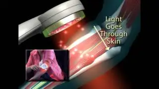 HSN Pain Clip