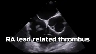 Thrombus in RA lead