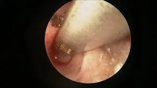 Полипэктомия из ушного прохода кошки. Endoscopic removal of ear polyps in a cat